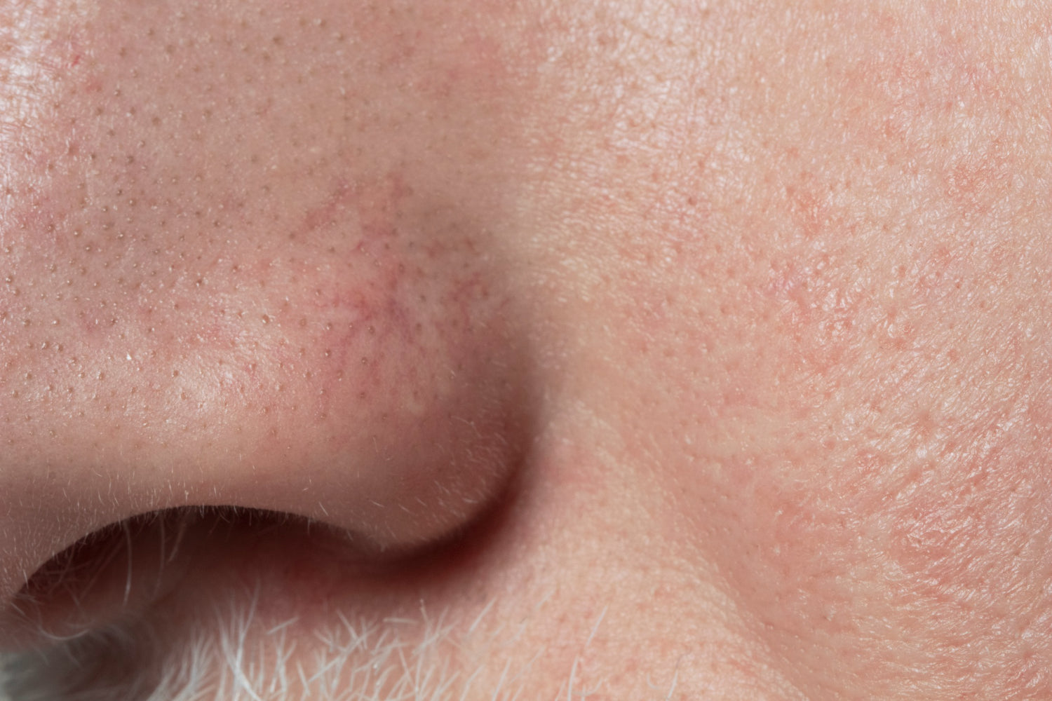 Clogged Pores: Why They Happen and How to Clear Them for Good