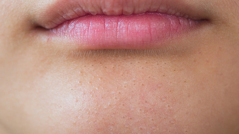 clogged pores on chin