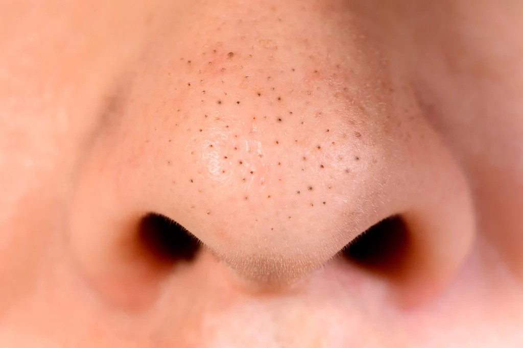 best way to get rid of blackheads