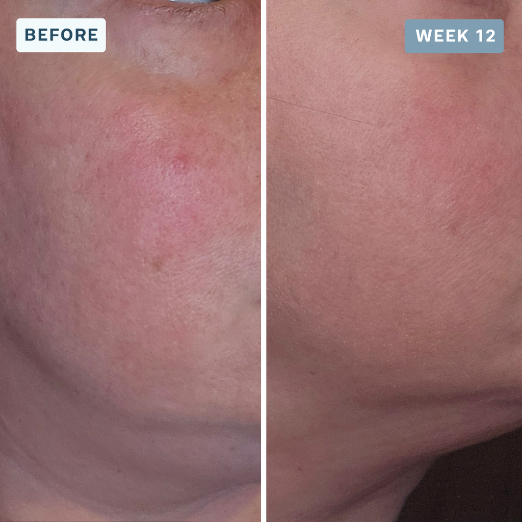 LuminX Pro - LED Face, Jawline & Lip Mask
