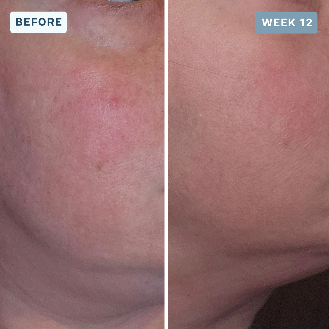 Dark spots & uneven tone