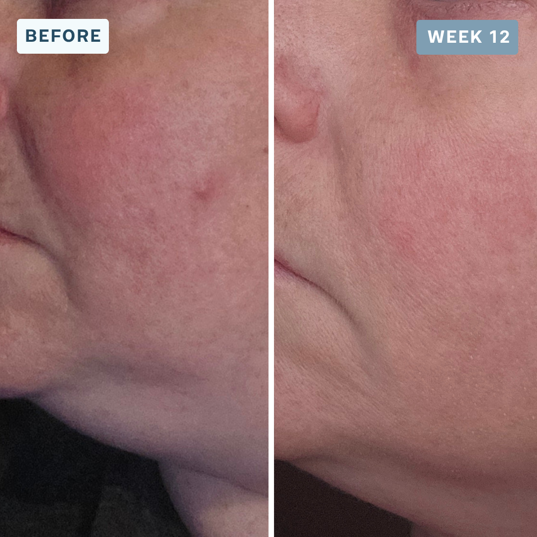 Acne & Breakouts