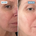 LuminX Pro - LED Face, Jawline & Lip Mask