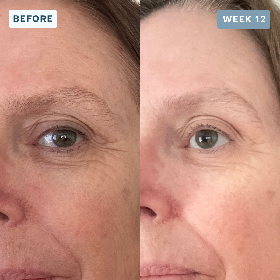 LuminX Pro - LED Face, Jawline & Lip Mask