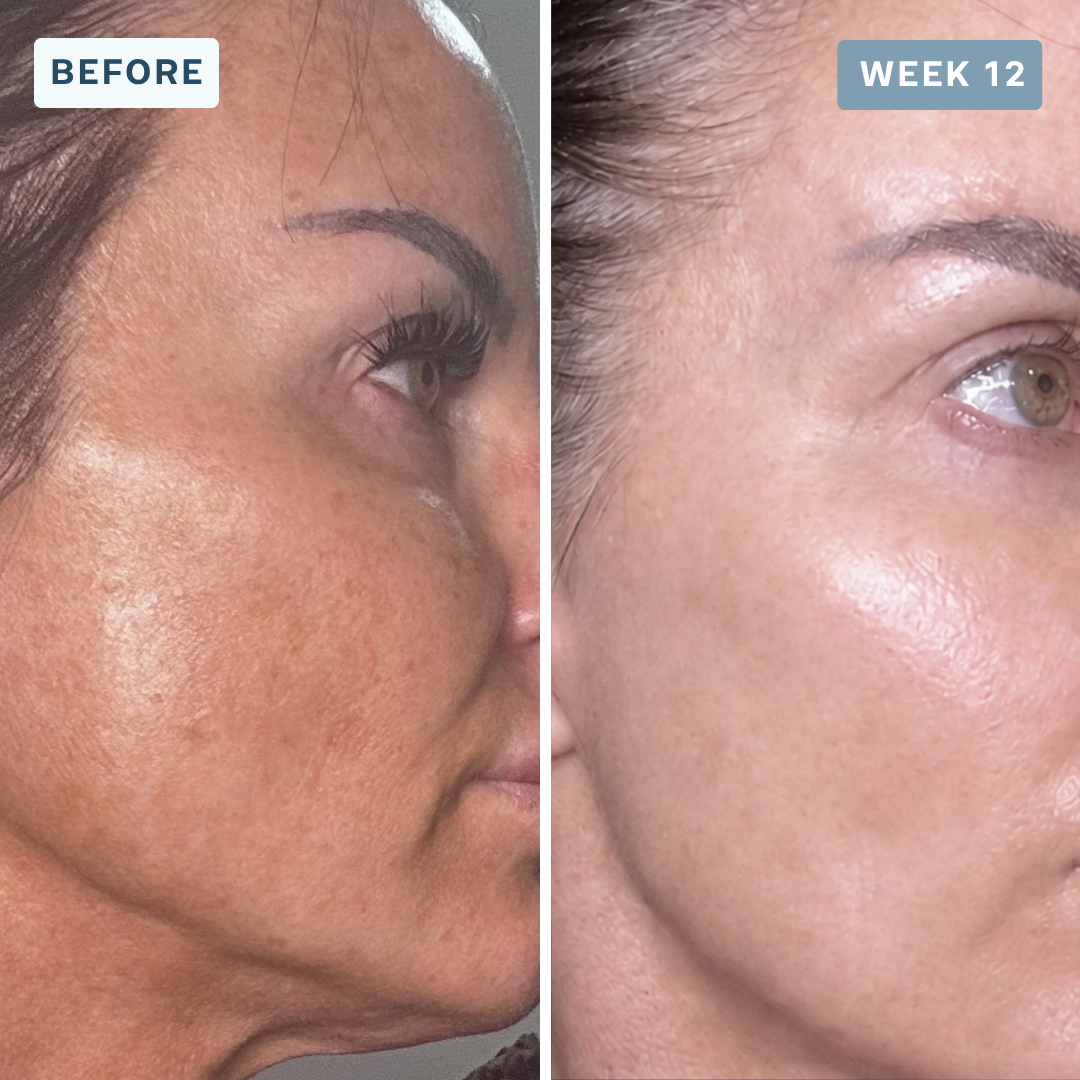 Dark spots & uneven tone