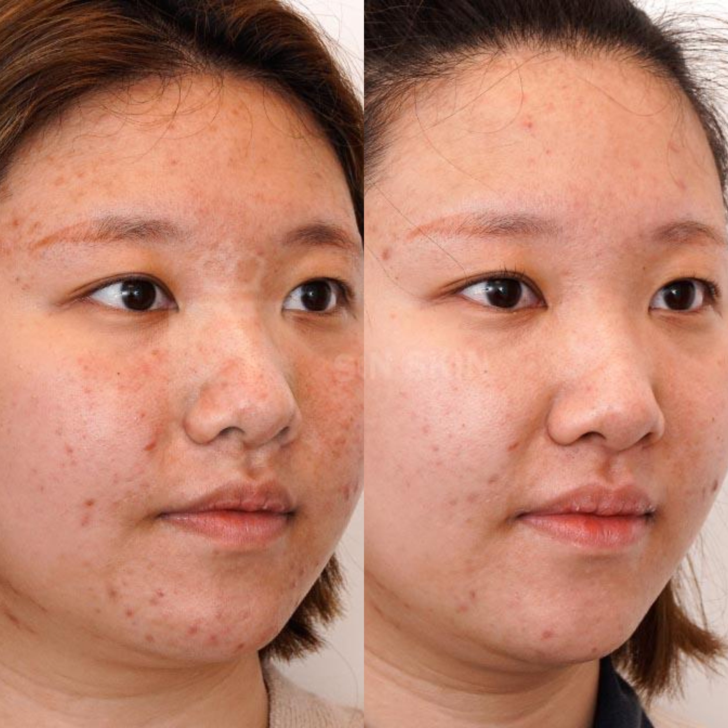 LED Face Mask Light Therapy | Red & Infrared Light |Free