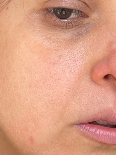 SKIN HYDRATION