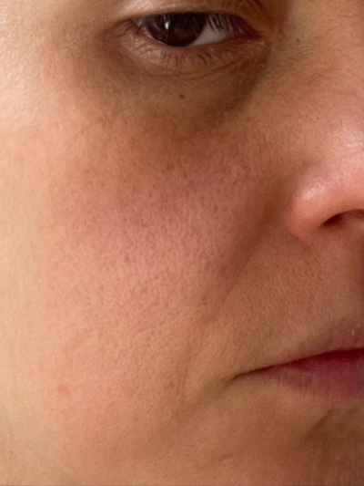SKIN HYDRATION
