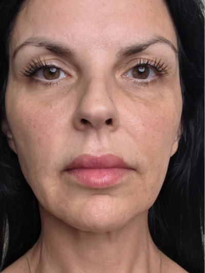 FINE LINES & WRINKLES