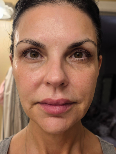 FINE LINES & WRINKLES